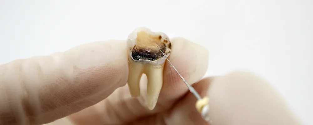 虫歯が進行して抜いた歯の断面と歯科用の器具｜シティデンタルクリニック ペリエ千葉エキナカ
