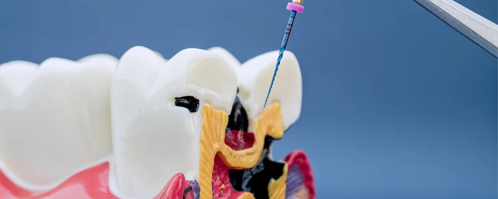 歯の模型の根管に細いファイルを差し込み、感染根管治療の様子を示した写真｜シティデンタルクリニック ペリエ千葉エキナカ